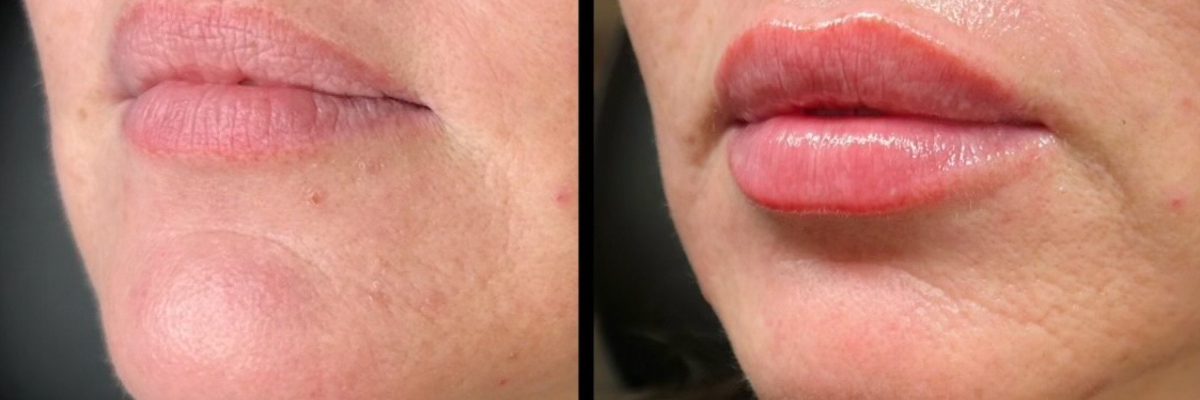 Aesthetic Unfiltered Aurora & Ocelli Aesthetics Terre Haute