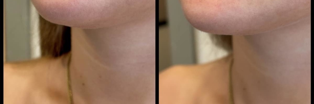 Aesthetic Unfiltered Aurora & Ocelli Aesthetics Terre Haute